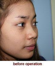 plastic_surgery_augmentation_rhinoplasty